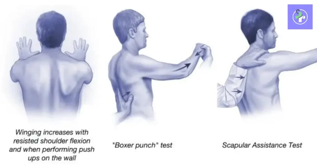 Injury to the Nerve to Serratus Anterior