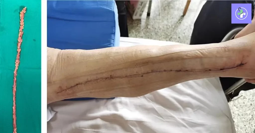Great Saphenous Vein