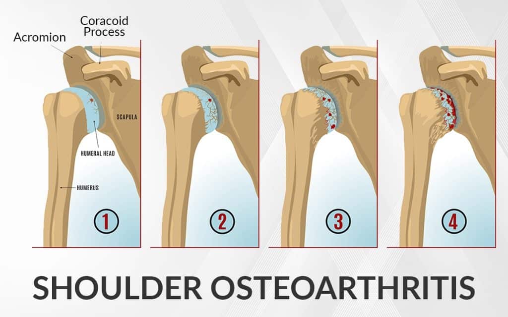 shoulder joint osteoarthritis
