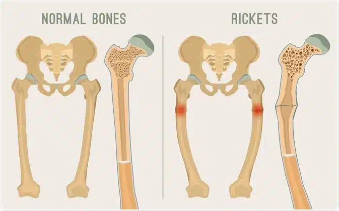 Diagnosis and Treatment of Rickets