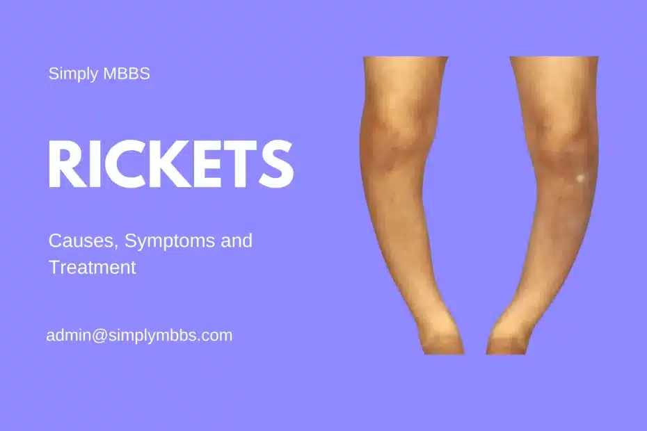Rickets: causes, symptoms, and treatment options