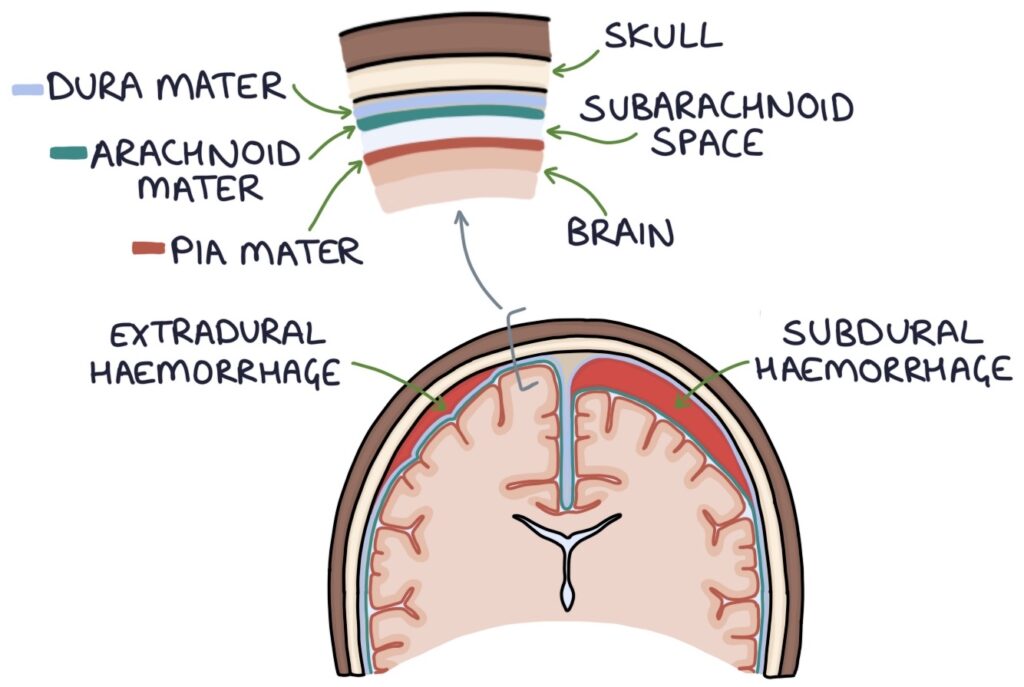 subdural hemorrhage