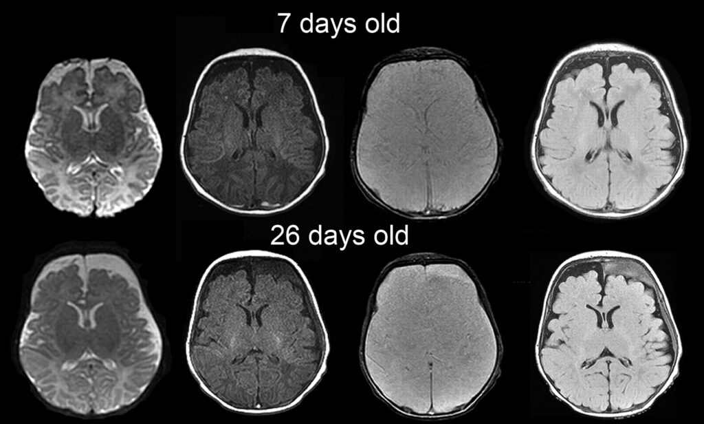 subdural hemorrhage