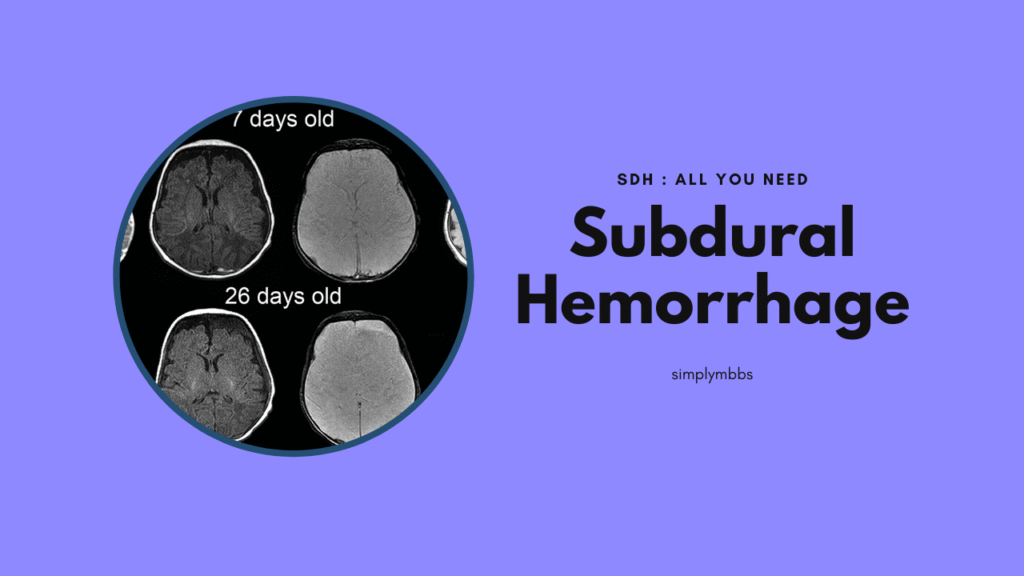 subdural hemorrhage sdh subdural hemorrhage subdural hemorrhage icd 10 hemorrhage subdural ct subdural hemorrhage subdural hemorrhage ct images epidural vs subdural hemorrhage icd 10 code for subdural hemorrhage subarachnoid hemorrhage vs subdural hematoma subdural vs subarachnoid hemorrhage difference between epidural and subdural hemorrhage epidural hemorrhage vs subdural hemorrhage nursing diagnosis for subdural hemorrhage subdural vs epidural hemorrhage epidural and subdural hemorrhage resumption anticoagulation after subdural hemorrhage spinal subdural hemorrhage subdural hemorrhage nursing diagnosis epidural hemorrhage vs subdural subdural hematoma vs subarachnoid hemorrhage
