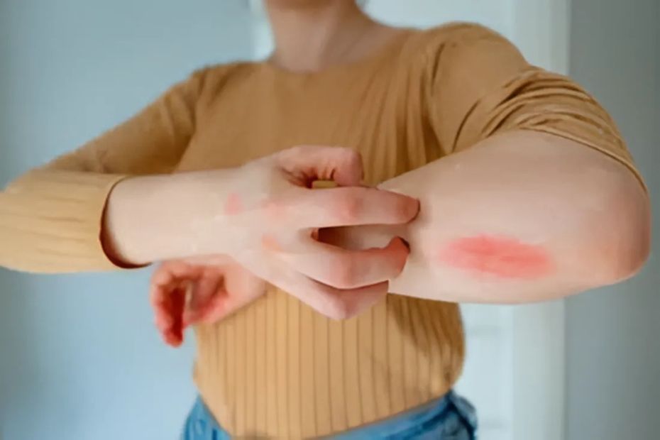anaphylactic-shock-image