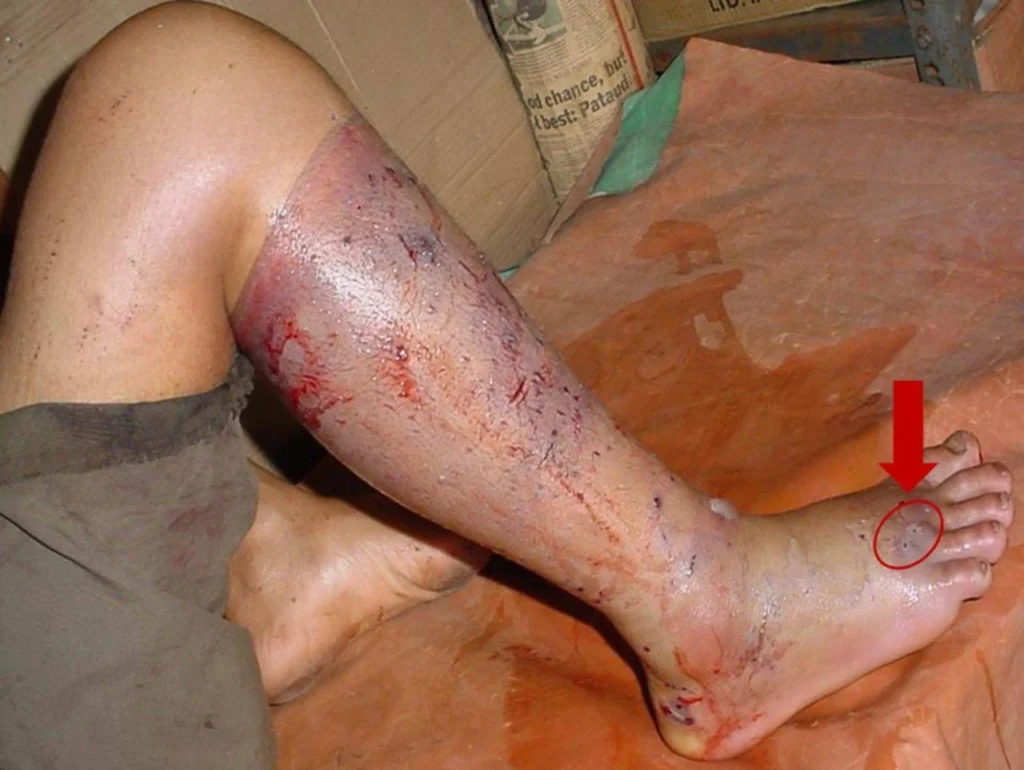 neurotoxicity-snake-bite